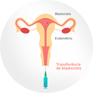Como a Transferência de blastocisto funciona?