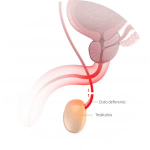 Saiba como a reversão da vasectomia é realizada