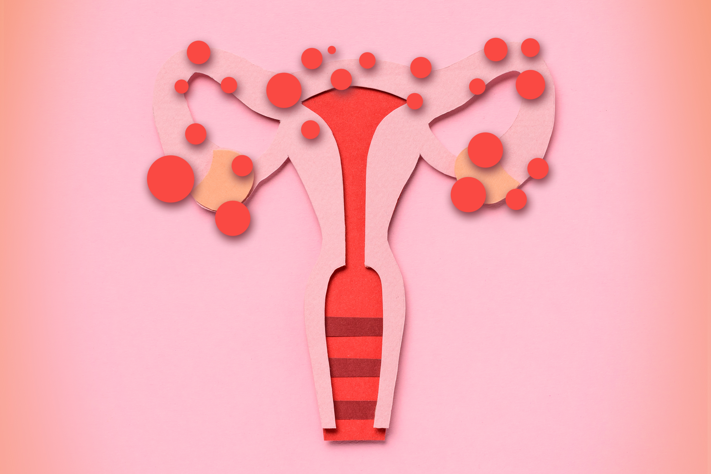 Endometriose: como é classificada?