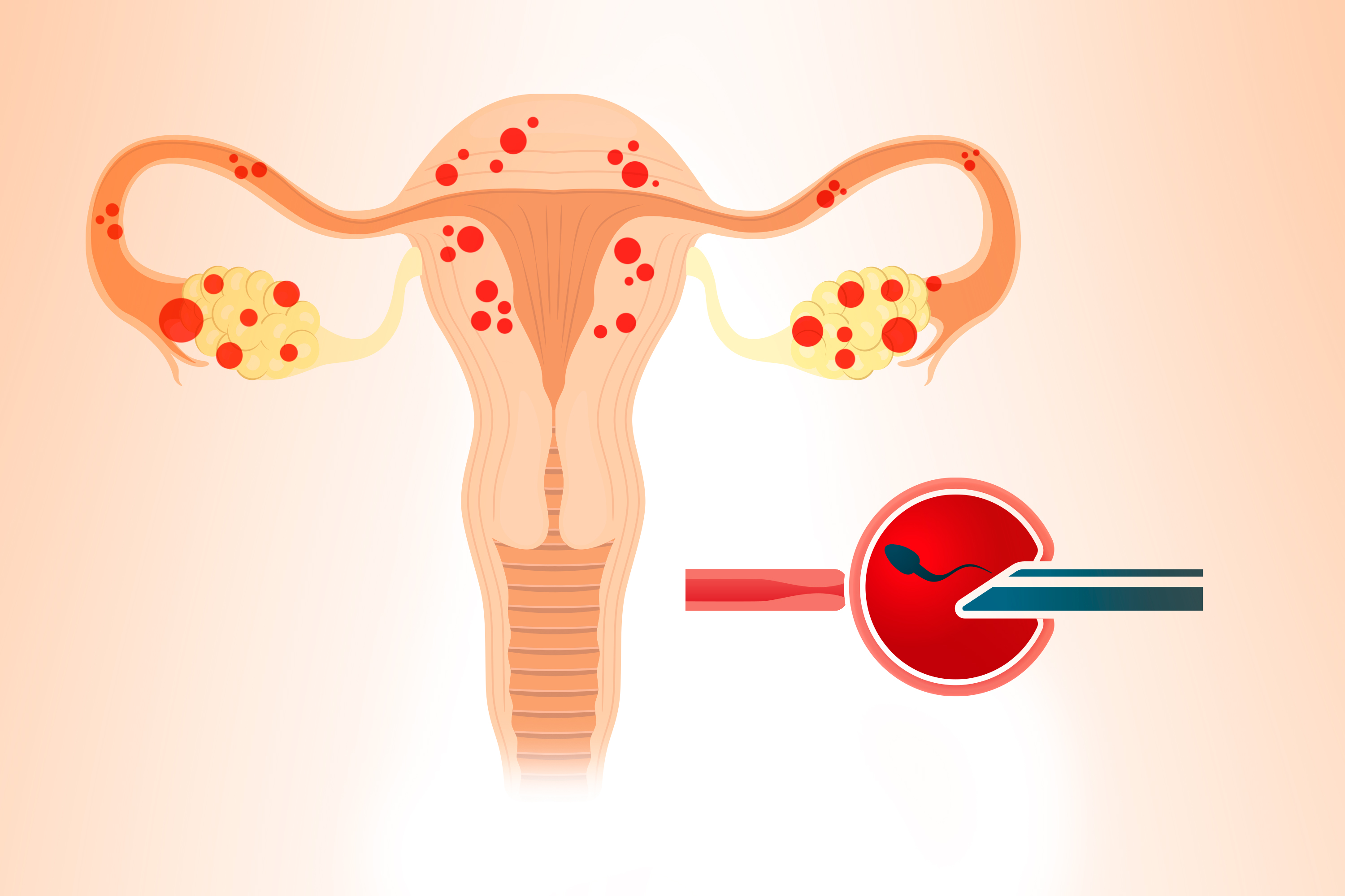 Endometriose: tratamento e reprodução assistida