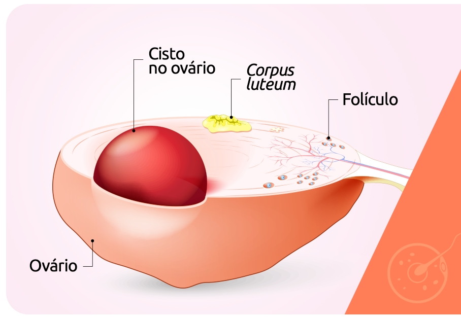 O que é ooforectomia?