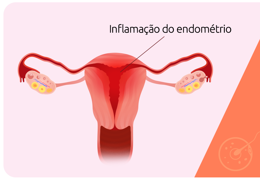 Endometrite e falha de implantação: existe relação?