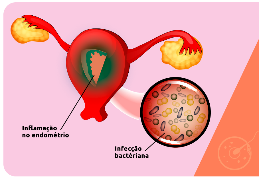 Endometrite: o que é?