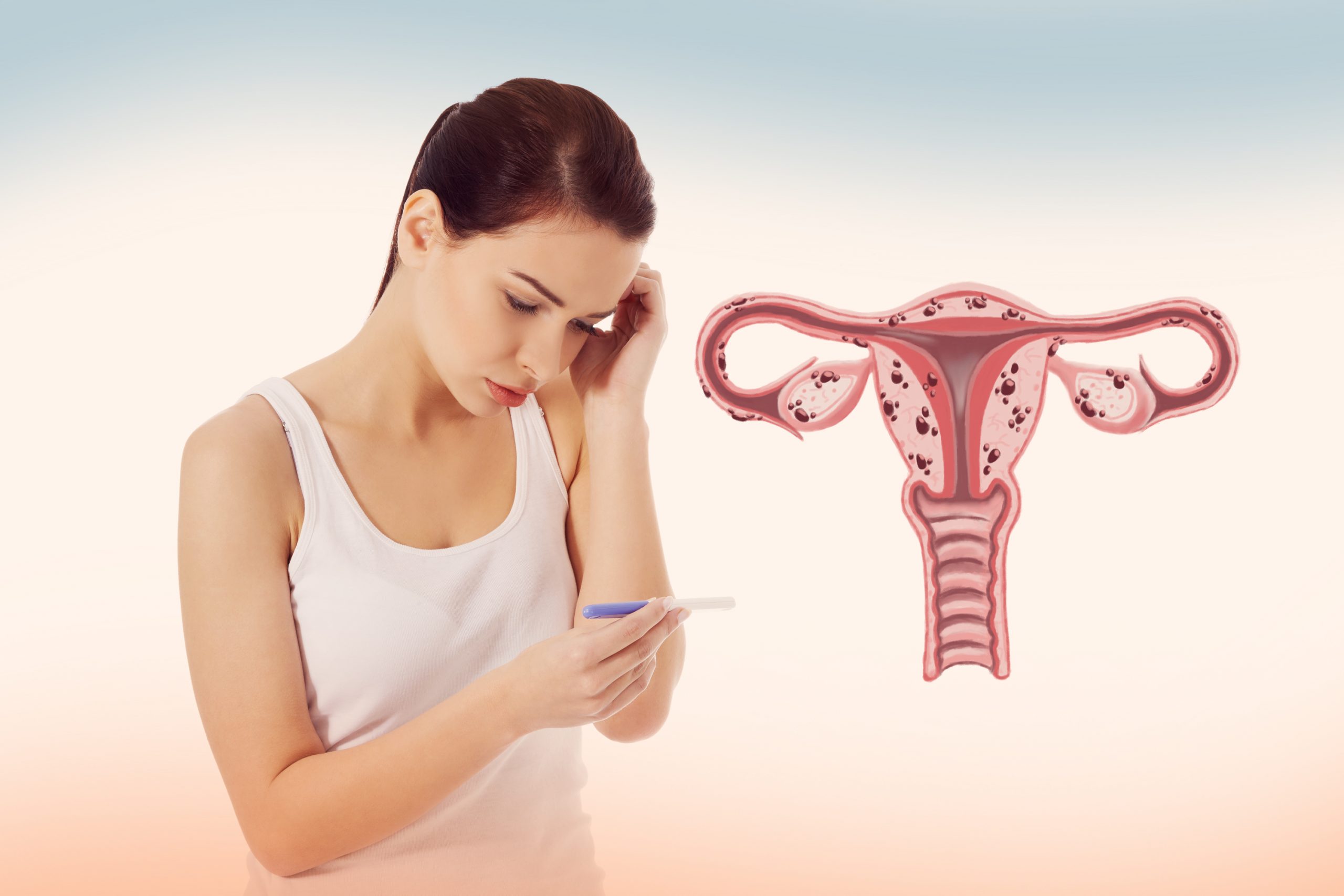 Infertilidade e endometriose: existe relação?