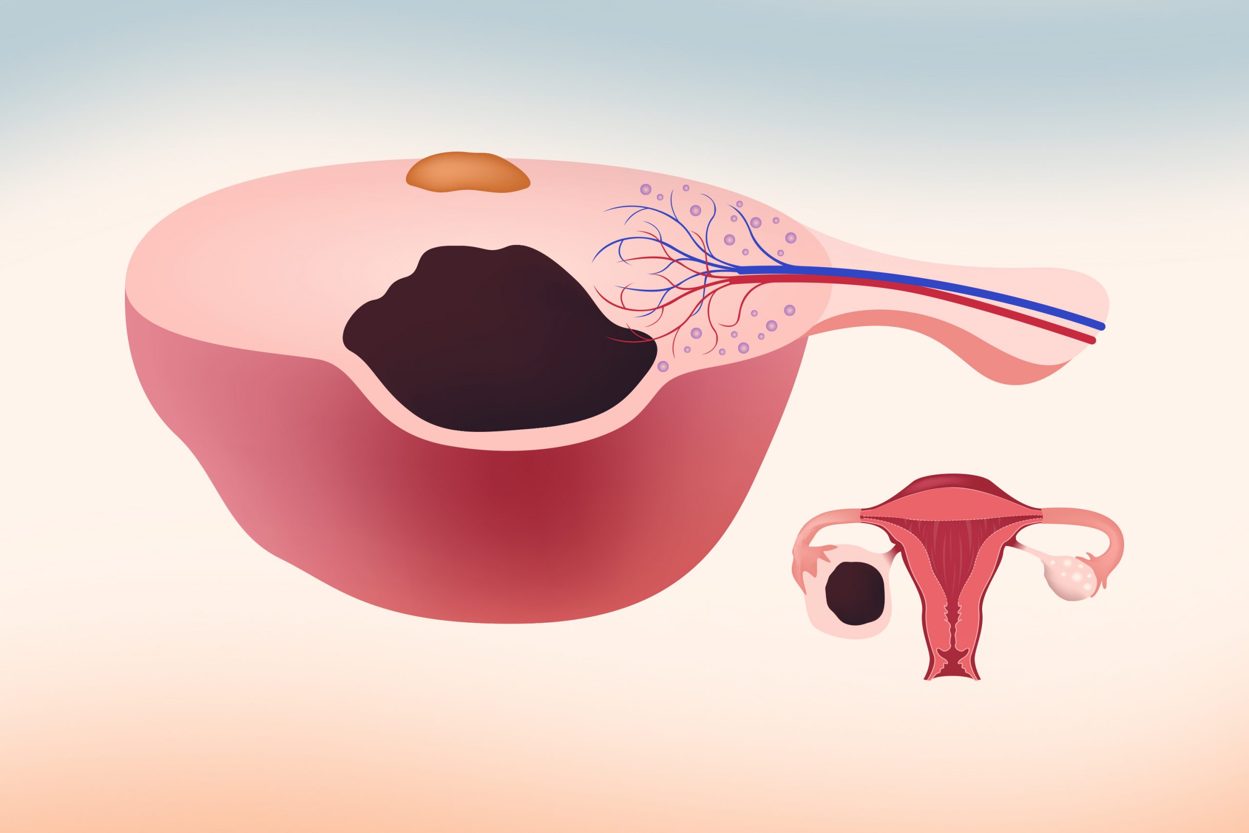 Endometriomas e reserva ovariana