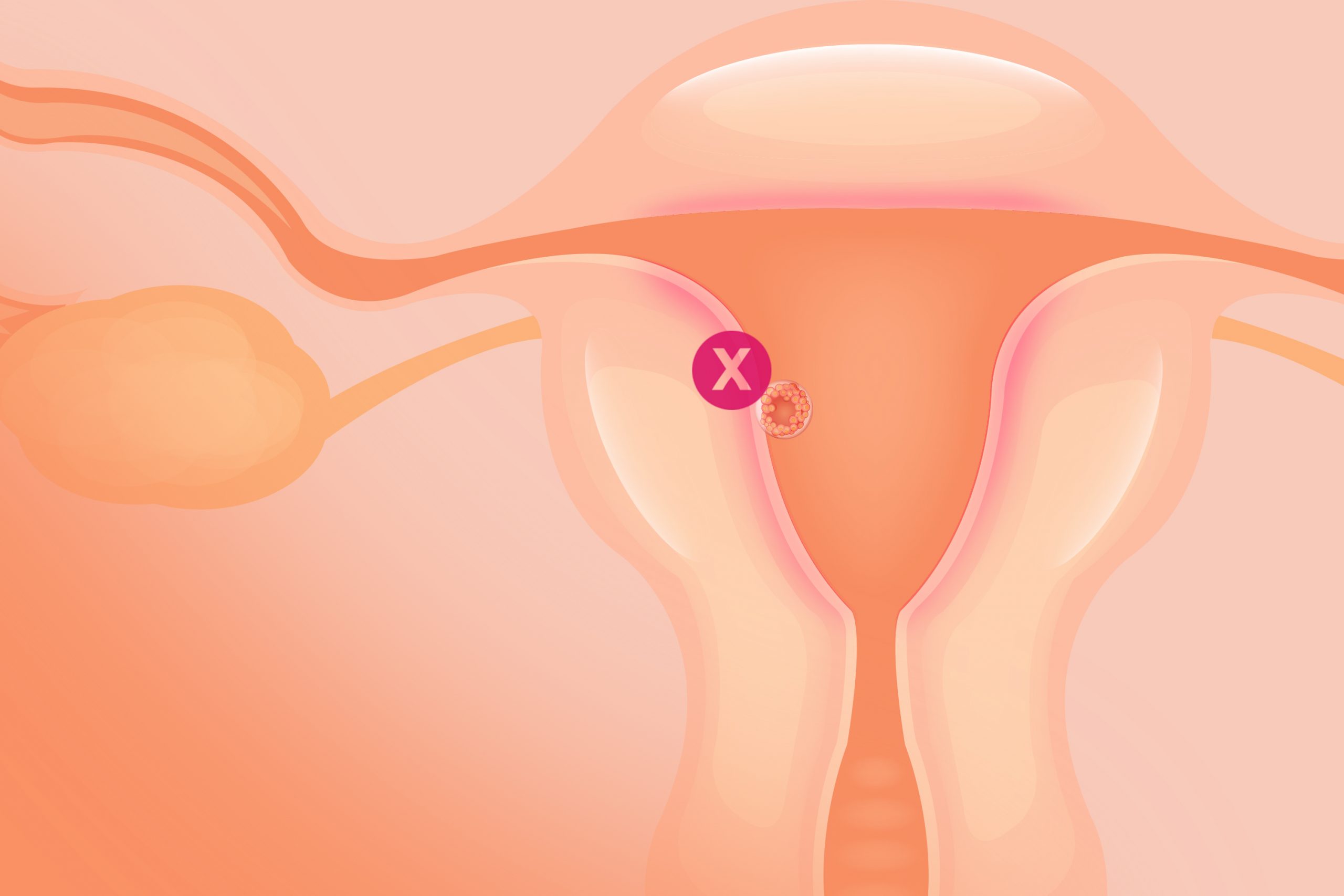 Endometrite e falhas de implantação: qual a relação?