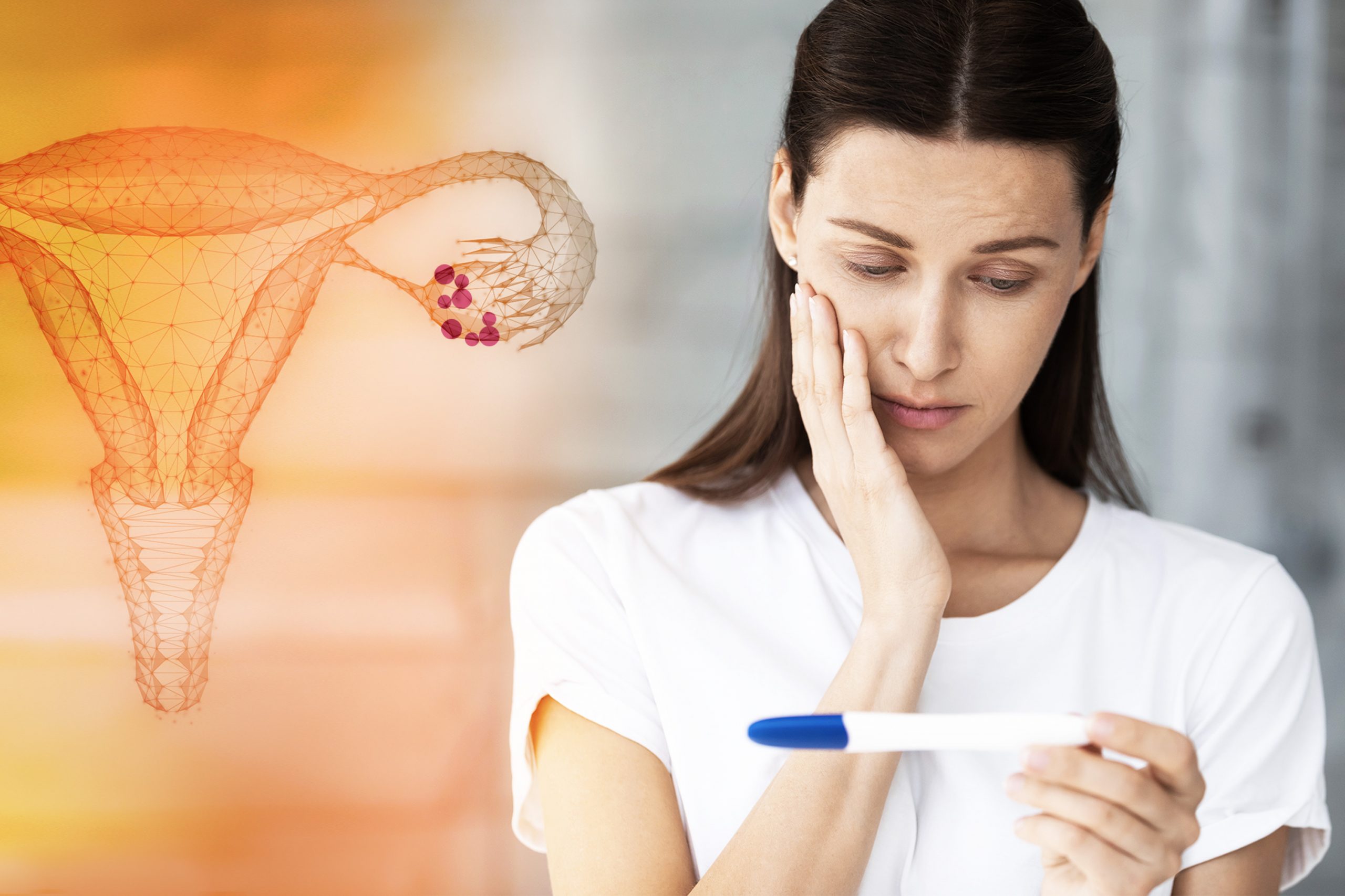 Endometrioma e infertilidade: existe relação?