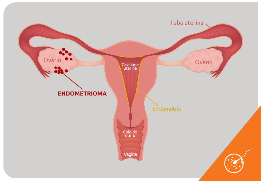 Endometriomas: o que são? - Art Fértil